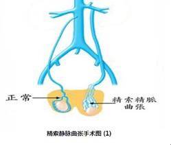 怎么治疗精索静脉曲张