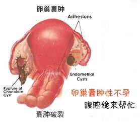 多囊卵巢综合症怎么预防