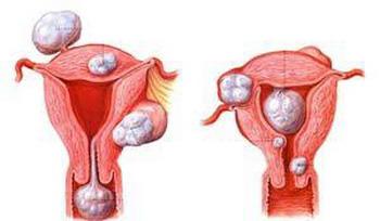 子宫肌瘤