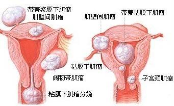 子宫肌瘤应该做哪些检查