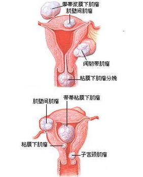 子宫肌瘤的症状