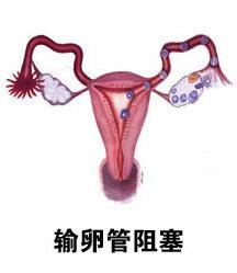 输卵管堵塞的原因有哪些