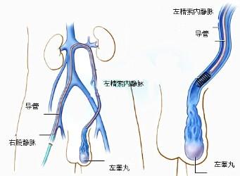 精索静脉曲张的原因是什么