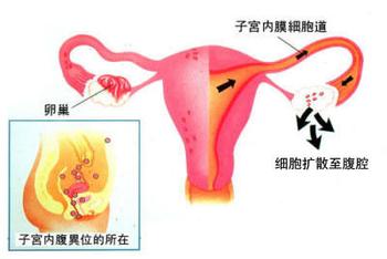 子宫内膜异位的症状有哪些