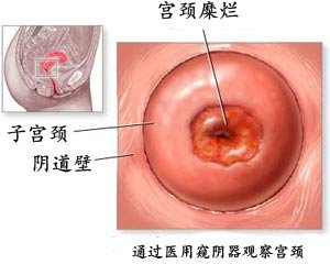 宫颈糜烂的早期症状有哪些