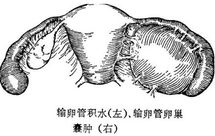 输卵管积水的原因是什么