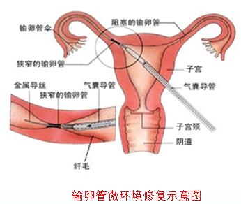 输卵管不通吃什么药