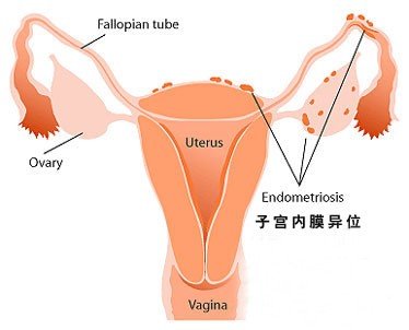子宫内膜异位症有什么相关检查?