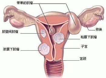 子宫肌瘤具体分为哪几类