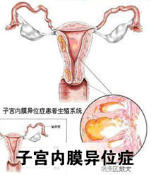 子宫内膜异位症有哪些常见的治疗方法
