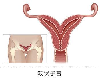 怎么治疗女性子宫小?