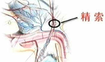 精索静脉曲张的具体情况如何?