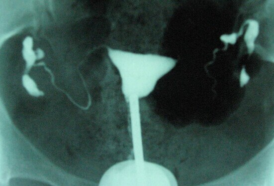 泉州石狮输卵管检查有哪些注意事项_输卵管性